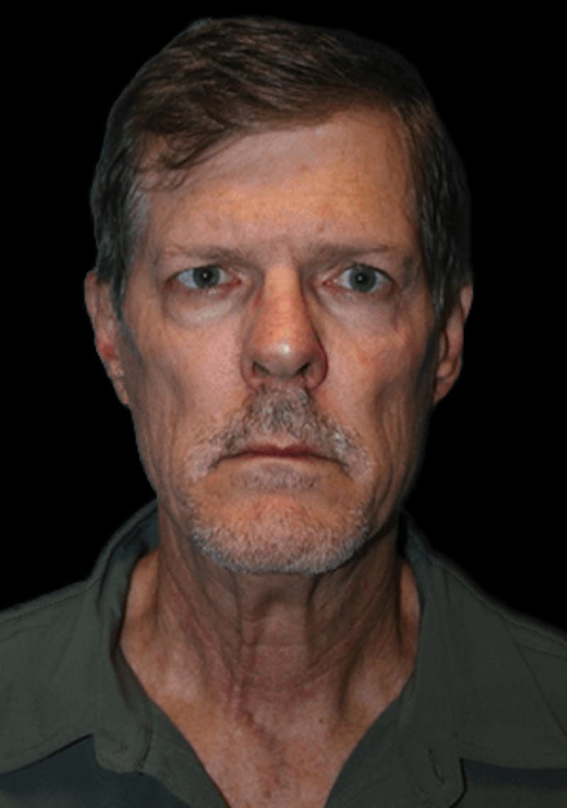 Facelift Before & After Gallery - Patient 277897 - Image 3