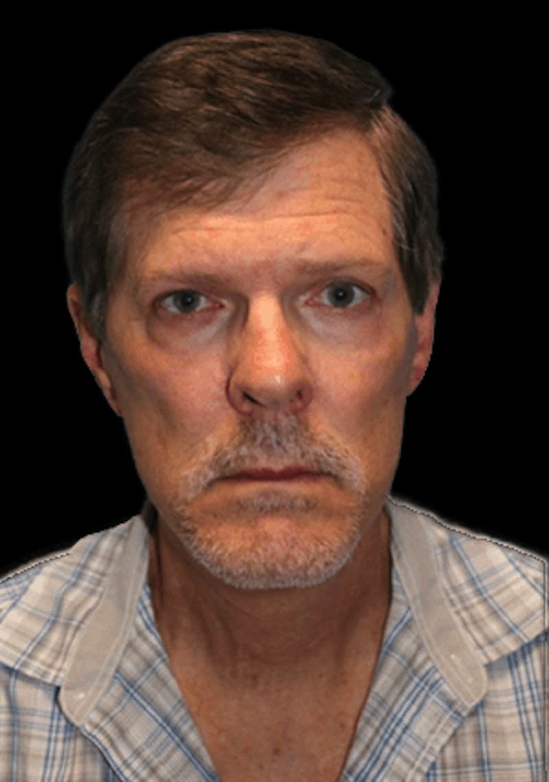 Facelift Before & After Gallery - Patient 277897 - Image 4
