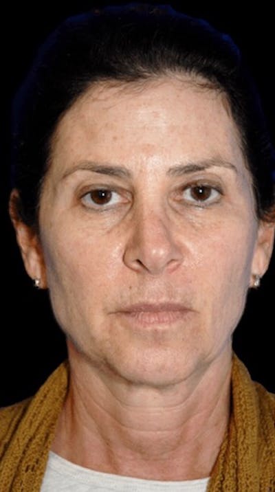 Facelift Before & After Gallery - Patient 122578 - Image 1