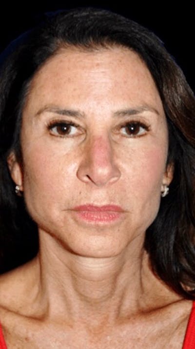 Facelift Before & After Gallery - Patient 122578 - Image 2