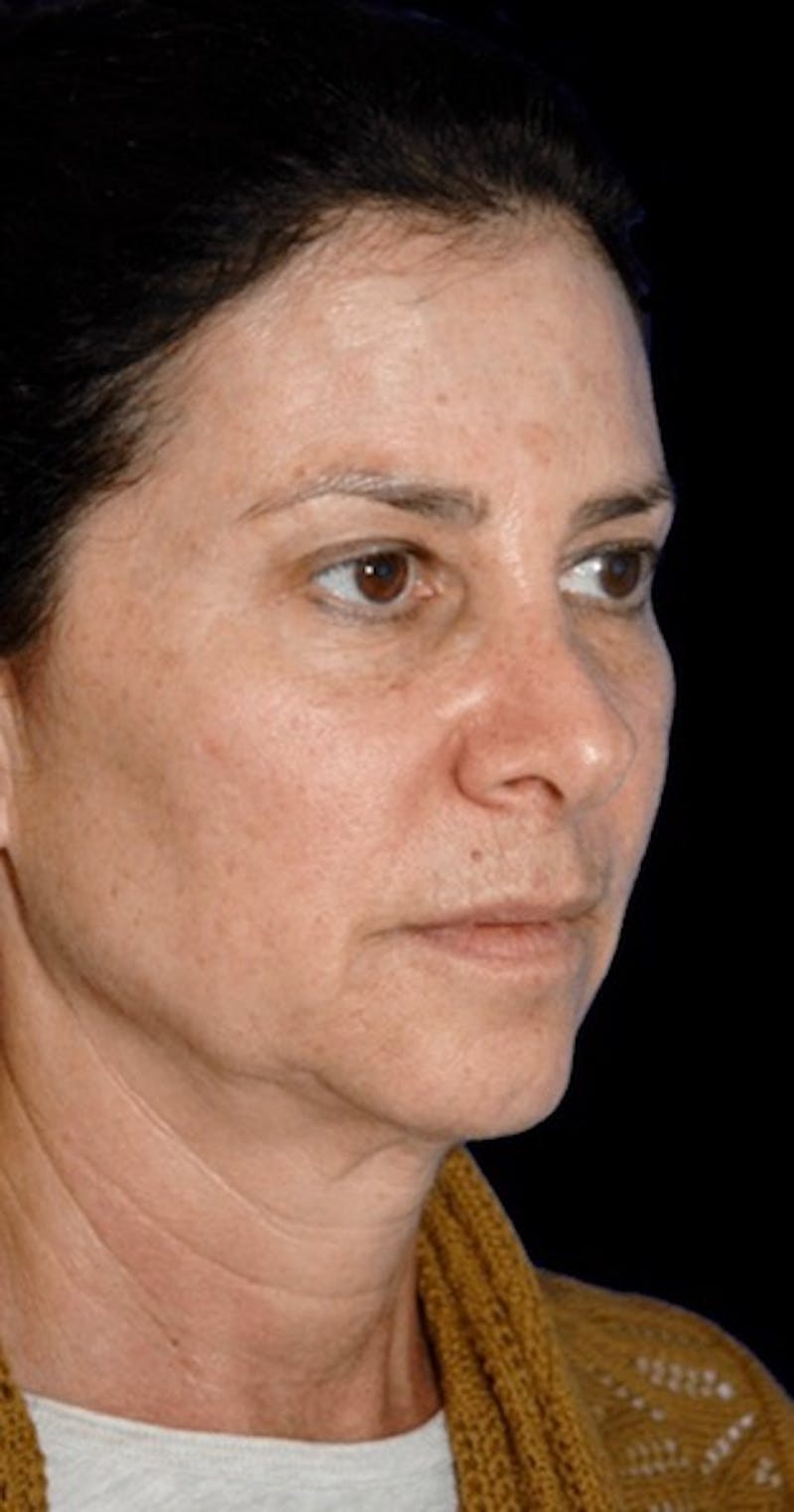Facelift Before & After Gallery - Patient 122578 - Image 3