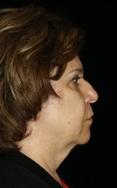Facelift Before & After Gallery - Patient 164546 - Image 1