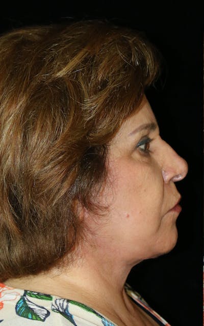 Facelift Before & After Gallery - Patient 164546 - Image 2