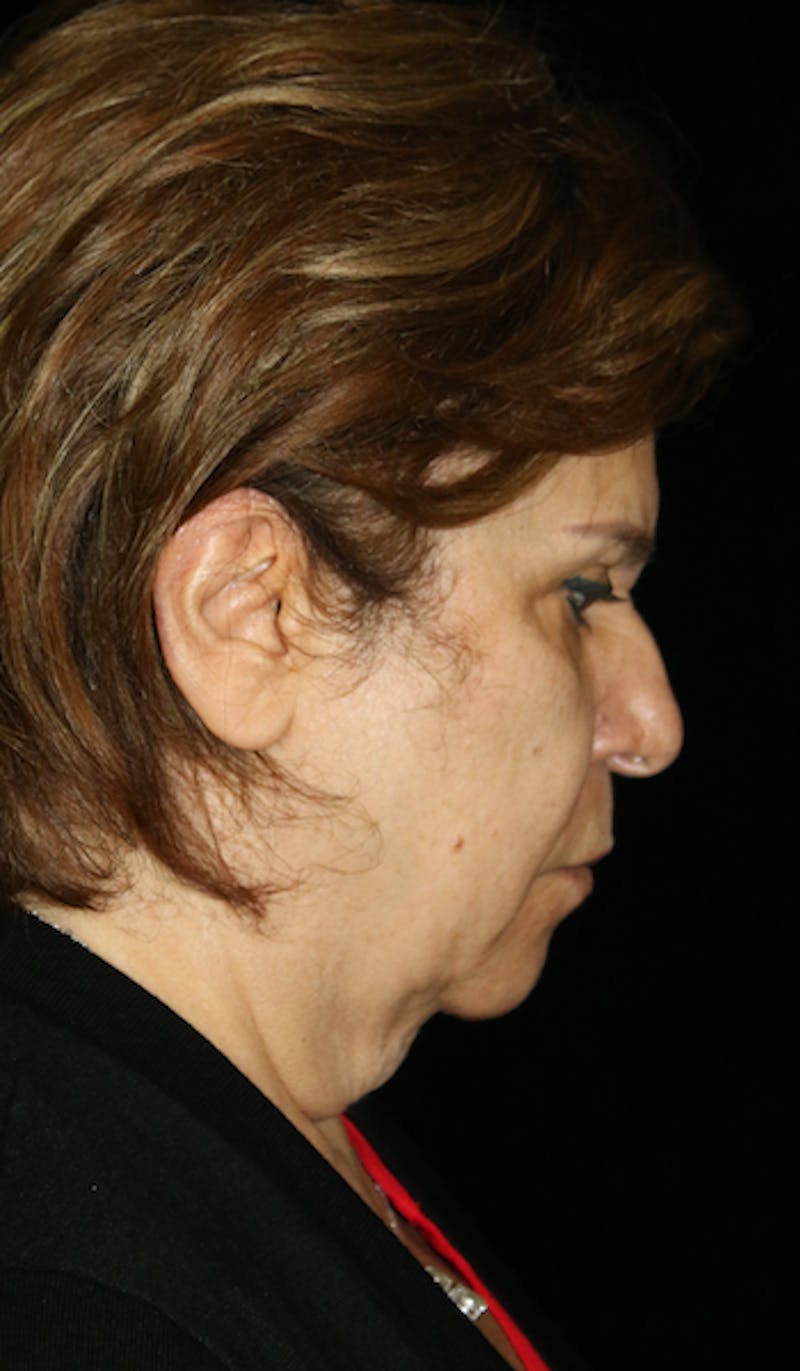 Facelift Before & After Gallery - Patient 164546 - Image 3