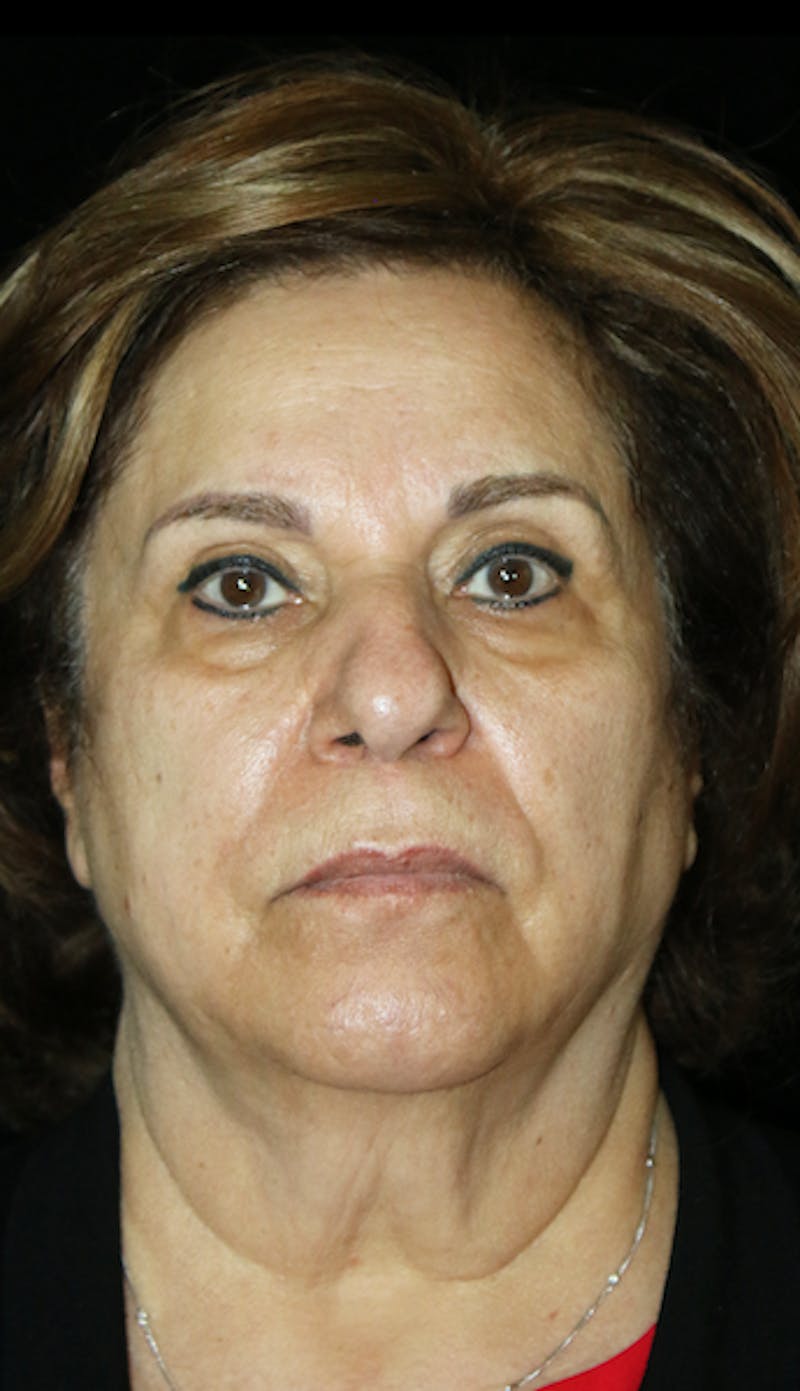 Facelift Before & After Gallery - Patient 164546 - Image 5