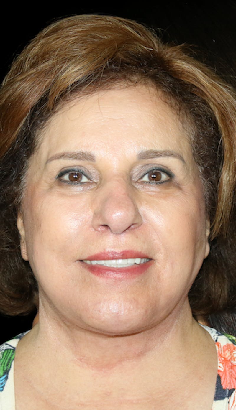 Facelift Before & After Gallery - Patient 164546 - Image 6