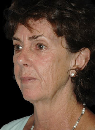 Facelift Before & After Gallery - Patient 986824 - Image 1