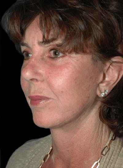 Facelift Before & After Gallery - Patient 986824 - Image 2