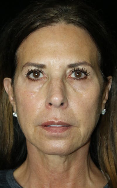 Facelift Before & After Gallery - Patient 226375 - Image 1