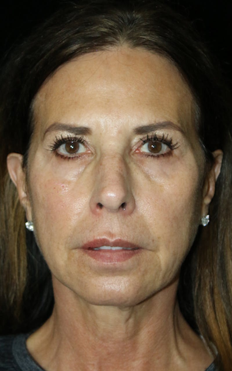 Facelift Before & After Gallery - Patient 226375 - Image 1