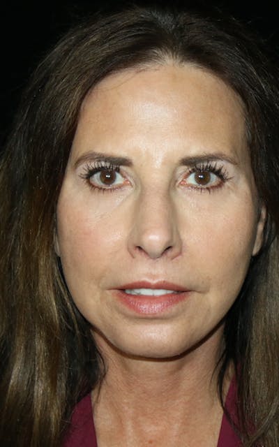 Facelift Before & After Gallery - Patient 226375 - Image 2