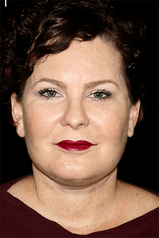 Facelift Before & After Gallery - Patient 177830 - Image 2