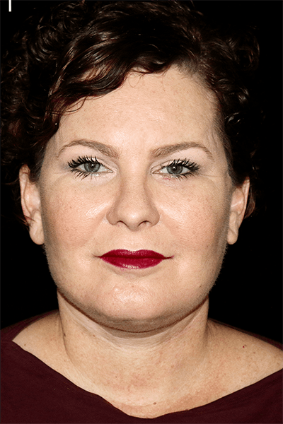 Facelift Before & After Gallery - Patient 177830 - Image 2
