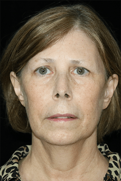 Facelift Before & After Gallery - Patient 190409 - Image 1