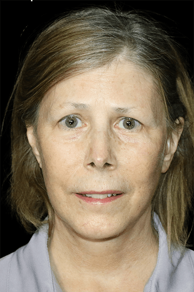 Facelift Before & After Gallery - Patient 190409 - Image 2
