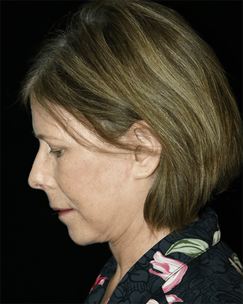 Facelift Before & After Gallery - Patient 190409 - Image 4
