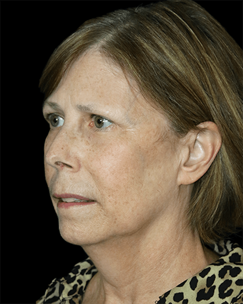 Facelift Before & After Gallery - Patient 190409 - Image 5