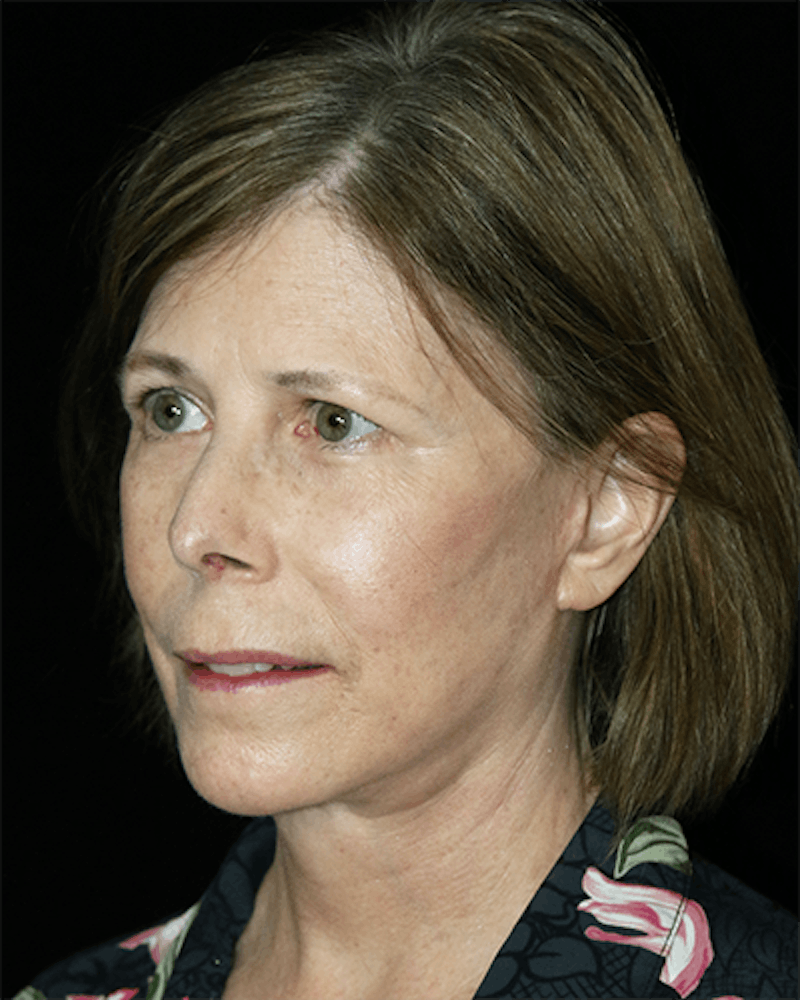 Facelift Before & After Gallery - Patient 190409 - Image 6