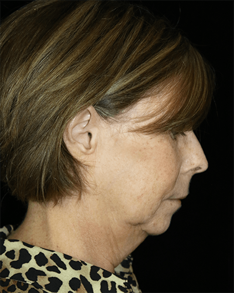 Facelift Before & After Gallery - Patient 190409 - Image 7