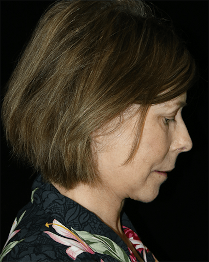 Facelift Before & After Gallery - Patient 190409 - Image 8