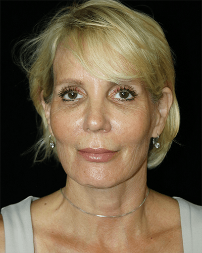 Facelift Before & After Gallery - Patient 211048 - Image 1