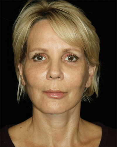 Facelift Before & After Gallery - Patient 211048 - Image 2