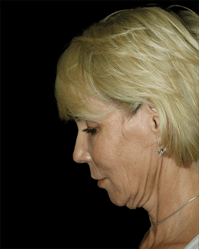 Neck Lift Before & After Gallery - Patient 375787 - Image 1