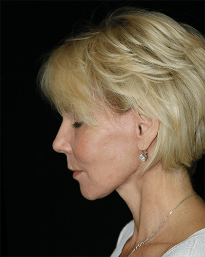Neck Lift Before & After Gallery - Patient 375787 - Image 2