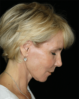 Facelift Before & After Gallery - Patient 211048 - Image 8