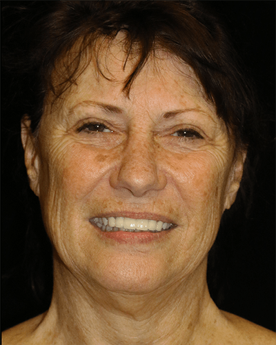 Facelift Before & After Gallery - Patient 319232 - Image 1