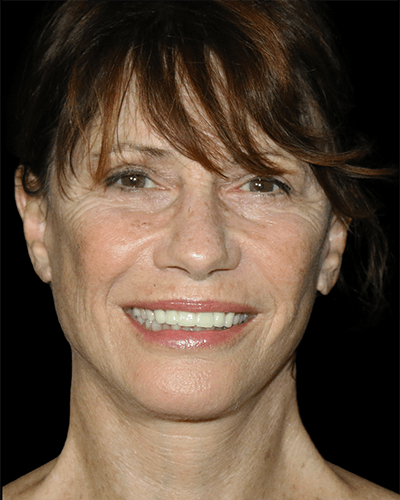 Facelift Before & After Gallery - Patient 319232 - Image 2