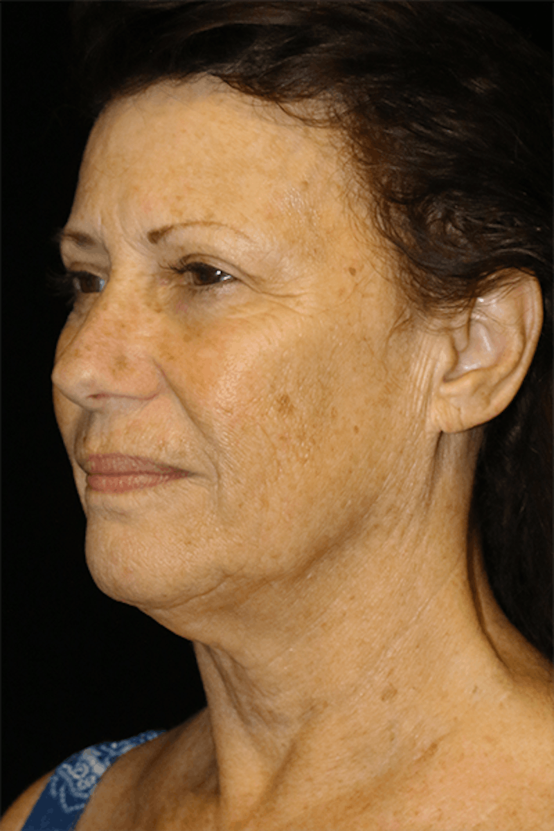 Facelift Before & After Gallery - Patient 319232 - Image 3