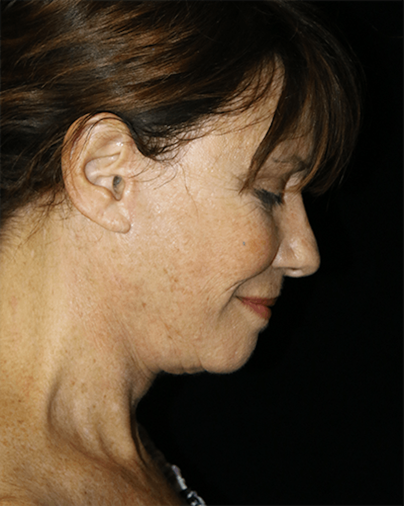 Facelift Before & After Gallery - Patient 319232 - Image 6