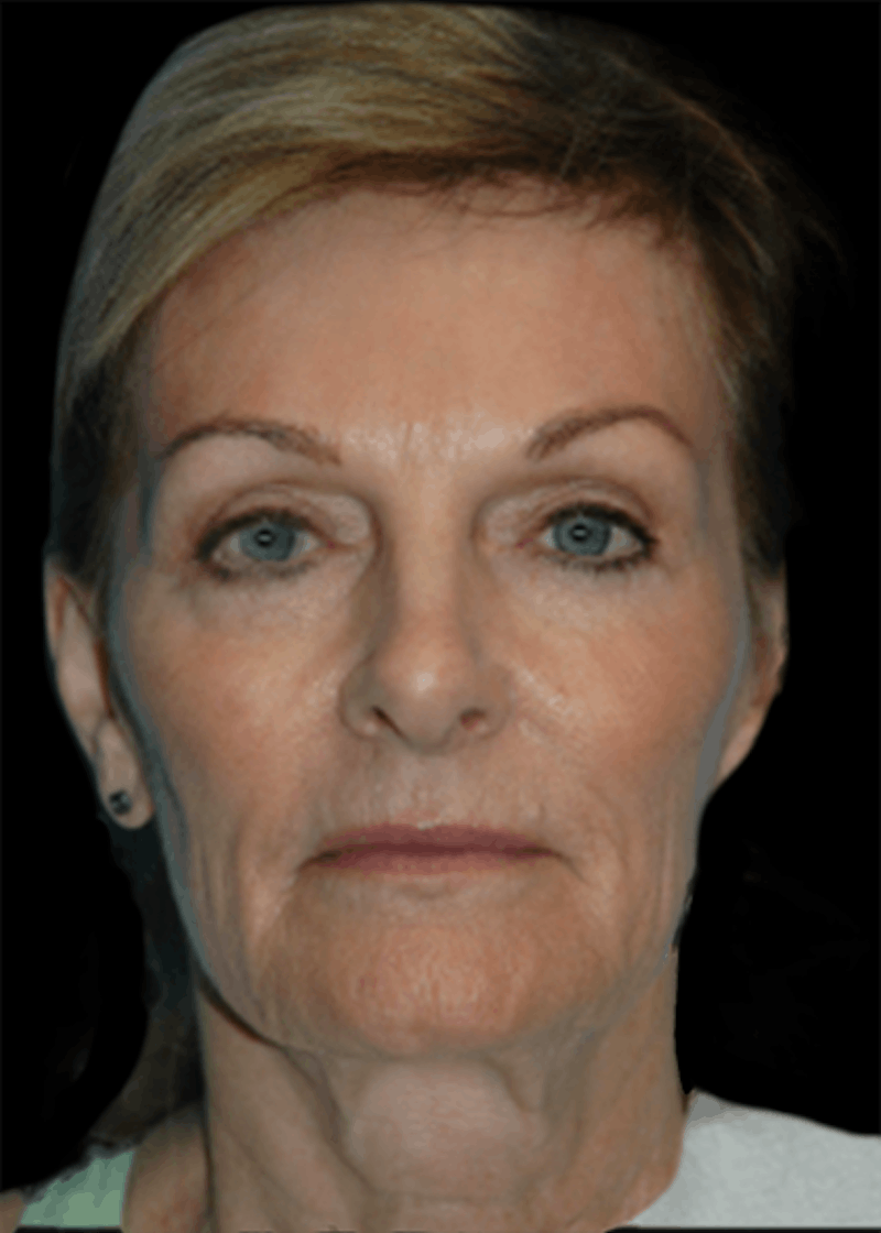 Facelift Before & After Gallery - Patient 219948 - Image 1