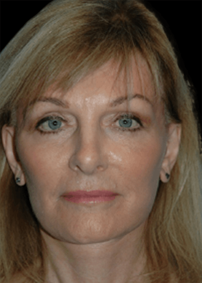 Facelift Before & After Gallery - Patient 219948 - Image 2