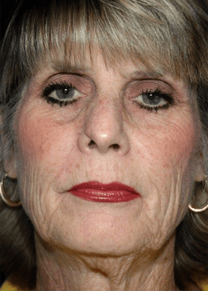 Facelift Before & After Gallery - Patient 223113 - Image 1