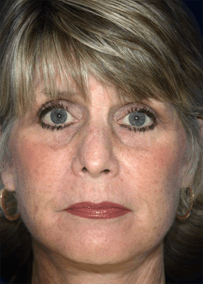 Facelift Before & After Gallery - Patient 223113 - Image 2