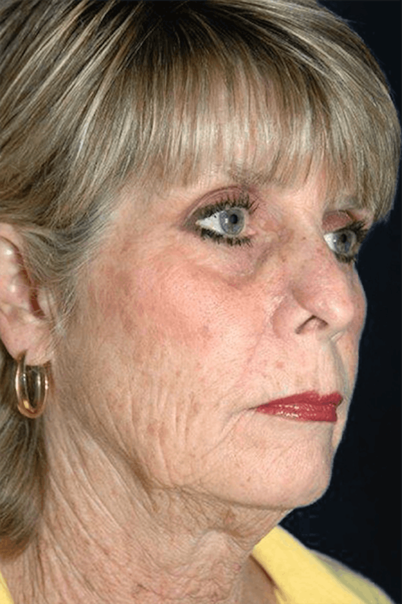 Facelift Before & After Gallery - Patient 223113 - Image 3