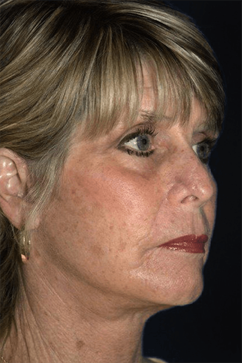 Facelift Before & After Gallery - Patient 223113 - Image 4
