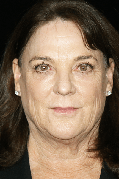 Facelift Before & After Gallery - Patient 157611 - Image 1