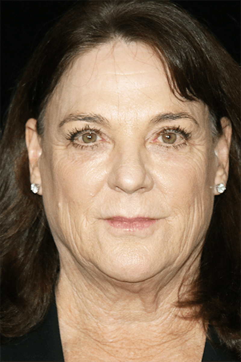 Facelift Before & After Gallery - Patient 157611 - Image 1
