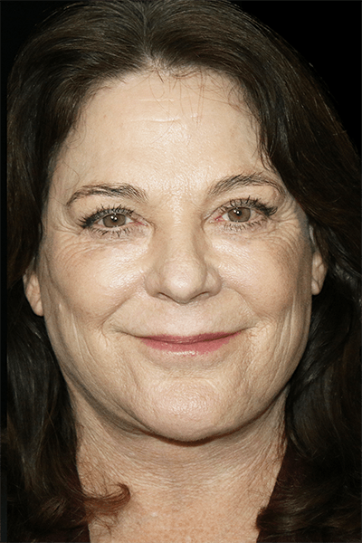 Facelift Before & After Gallery - Patient 157611 - Image 2