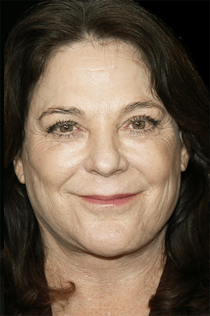 Facelift Before & After Gallery - Patient 157611 - Image 2