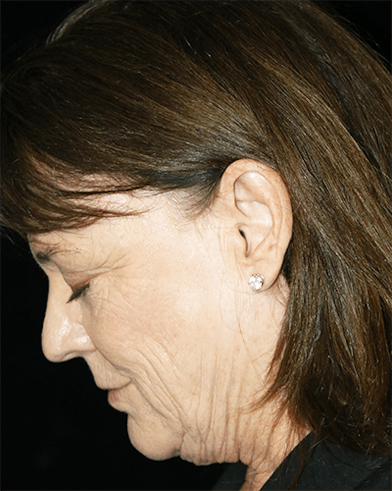 Facelift Before & After Gallery - Patient 157611 - Image 3