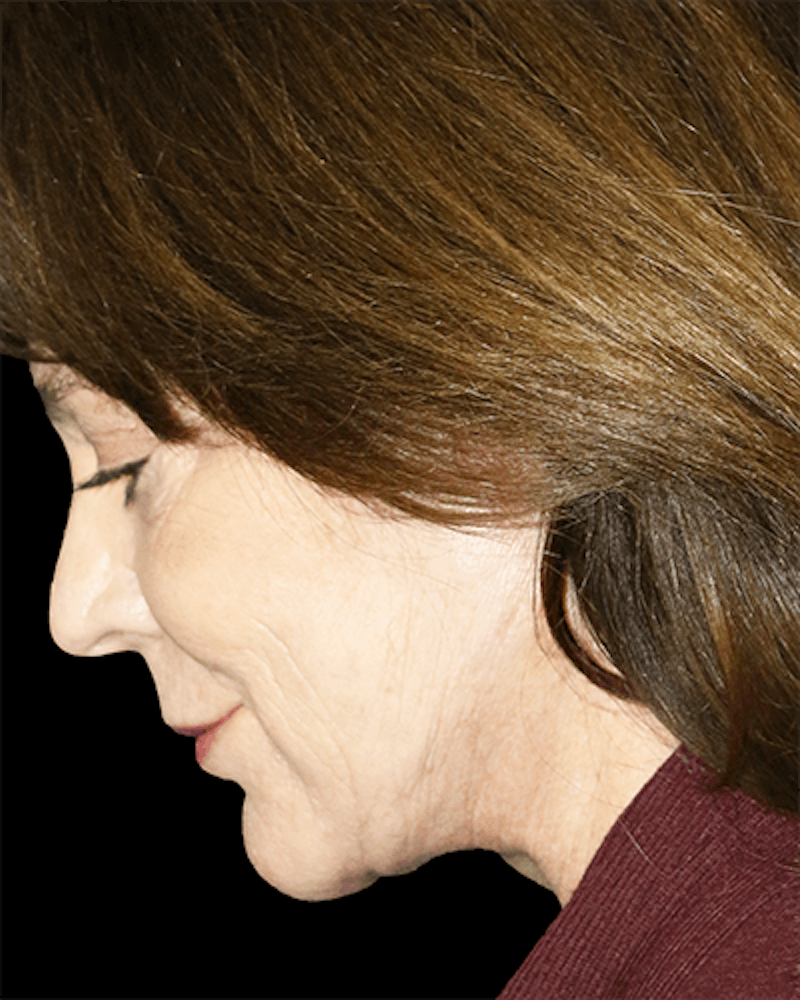 Facelift Before & After Gallery - Patient 157611 - Image 4