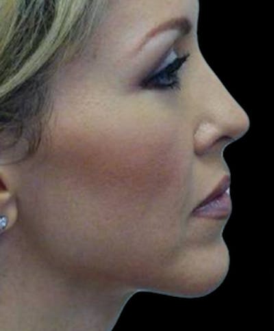 Genioplasty Before & After Gallery - Patient 127164 - Image 1