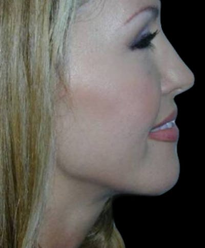Genioplasty Before & After Gallery - Patient 127164 - Image 2