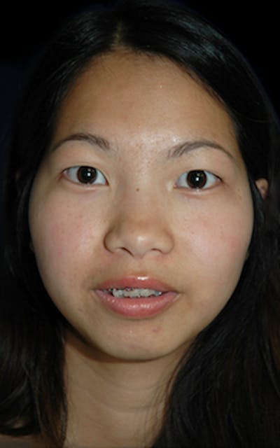 Genioplasty Before & After Gallery - Patient 407692 - Image 1