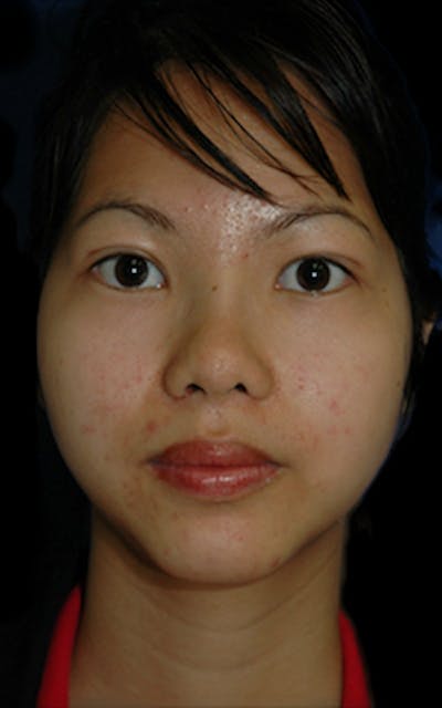 Genioplasty Before & After Gallery - Patient 407692 - Image 2