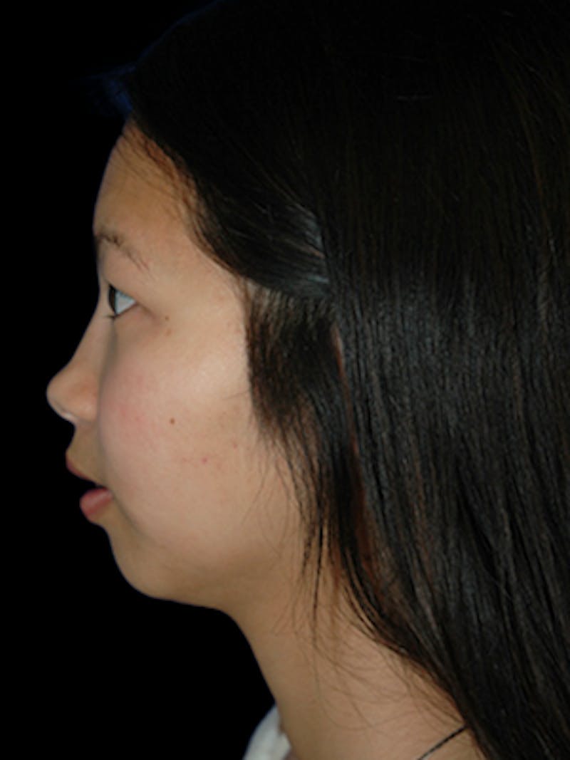 Genioplasty Before & After Gallery - Patient 407692 - Image 3